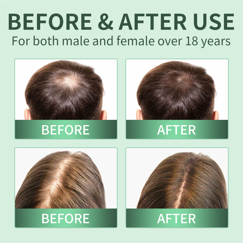 Hair Growth Spray,Scalp Scrub, - Scalp Scrub Exfoliant のレビューと価格